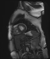 Cardiac amyloidosis (Radiopaedia 51404-57150 Sagittal CINE SSFP 113).jpg