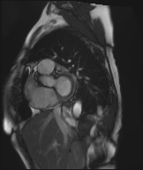 Cardiac amyloidosis (Radiopaedia 51404-57150 Sagittal CINE SSFP 255).jpg