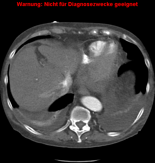 File:Cardiac perforation following transcatheter aortic valve implantation (Radiopaedia 23714-23863 A 16).png