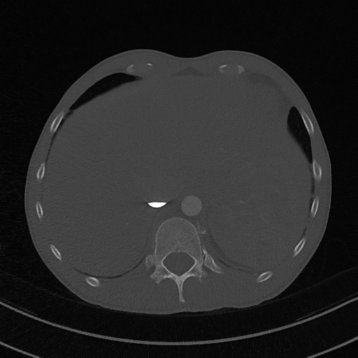 File:Cardiac tumor - undifferentiated pleomorphic sarcoma (Radiopaedia 45844-50134 Axial bone window 63).png