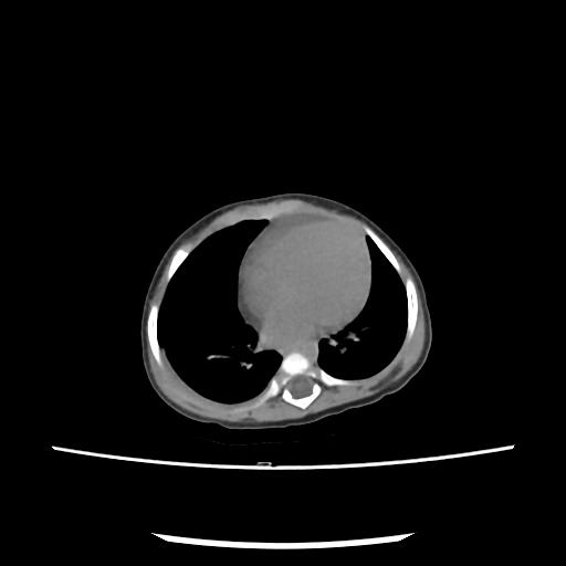 Caroli disease with autosomal recessive polycystic kidney disease (ARPKD) (Radiopaedia 89651-106703 E 1).jpg