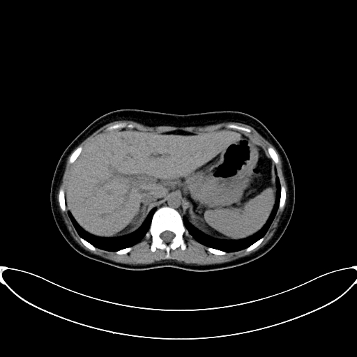 Caroli disease with medullary sponge kidney (Radiopaedia 82622-96804 Axial non-contrast 19).jpg