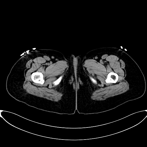 Caroli disease with medullary sponge kidney (Radiopaedia 82622-96804 Axial non-contrast 84).jpg
