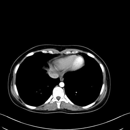Caroli disease with medullary sponge kidney (Radiopaedia 82622-96804 C 10).jpg