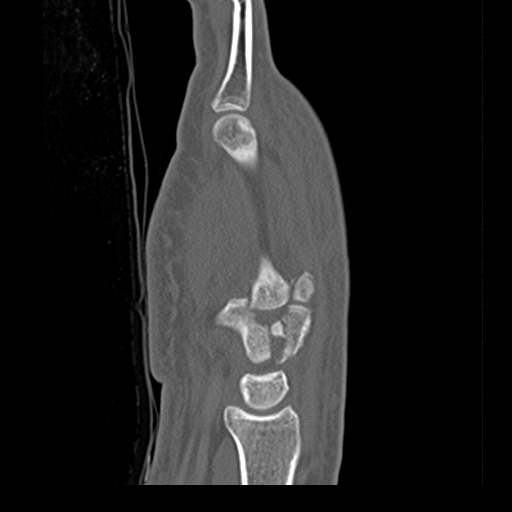 File:Carpo-metacarpal fracture-dislocations with hamatum split fracture (Radiopaedia 18482-18343 Sagittal bone window 9).jpg