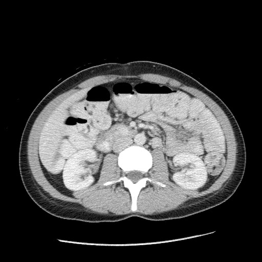Castleman disease with fibrous pseudotumor in the abdomen (Radiopaedia 77296-89373 A 57).jpg