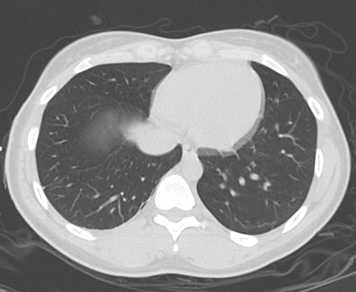 File:Catamenial pneumothorax (Radiopaedia 54382-60600 Axial 54).png