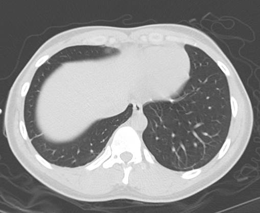 File:Catamenial pneumothorax (Radiopaedia 54382-60600 Axial 62).png
