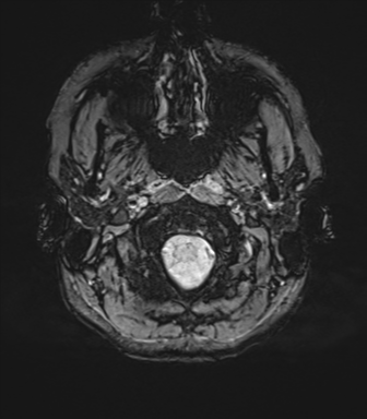 File:Cavernoma with bleed - midbrain (Radiopaedia 54546-60773 Axial SWI 4).png