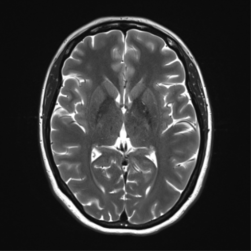 File:Cavernoma with bleed - midbrain (Radiopaedia 54546-60773 Axial T2 20).png