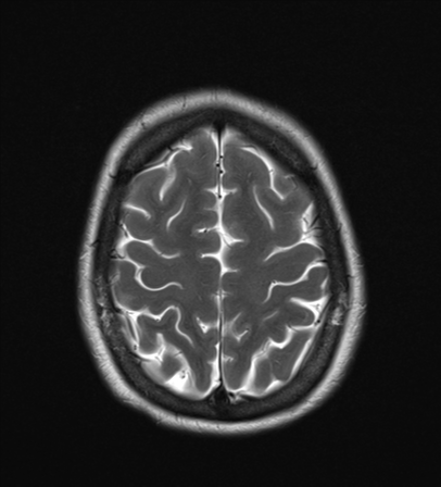 File:Cavernoma with bleed - midbrain (Radiopaedia 54546-60774 Axial T2 23).png