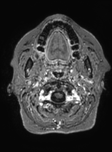 Cavernous hemangioma of the cerebellar falx (Radiopaedia 73025-83724 Axial T1 C+ 338).jpg