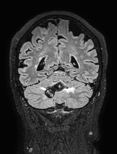 Cavernous hemangioma of the cerebellar falx (Radiopaedia 73025-83724 Coronal FLAIR 257).jpg