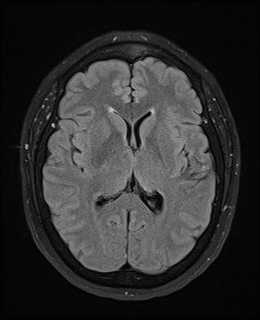 File:Cavernous sinus meningioma (Radiopaedia 63682-72367 Axial FLAIR 13).jpg