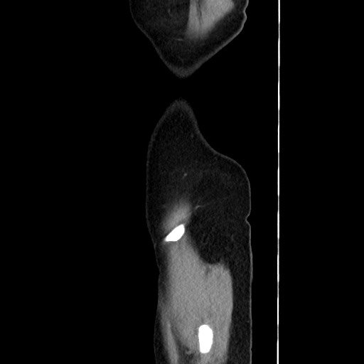Cecal adenocarcinoma (Radiopaedia 75909-87331 C 67).jpg