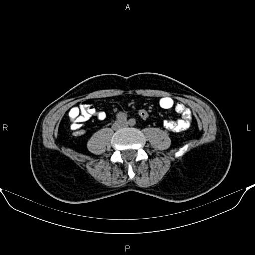 Cecal adenocarcinoma (Radiopaedia 85324-100916 Axial non-contrast 60).jpg