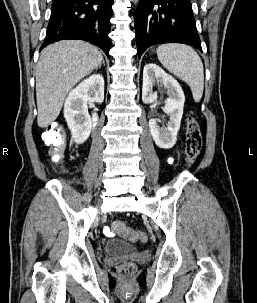 Cecal cancer with appendiceal mucocele (Radiopaedia 91080-108651 D 50).jpg