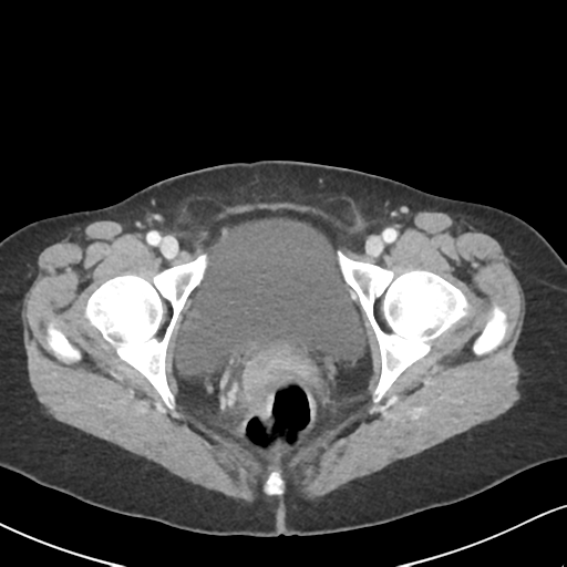 Cecal internal hernia through the foramen of Winslow (Radiopaedia 44820-48651 B 74).png