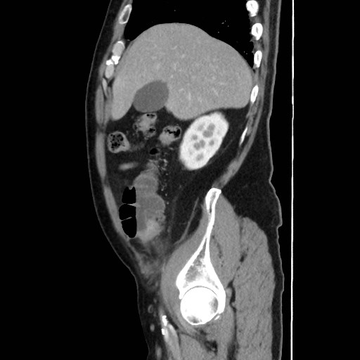 Cecal mass causing appendicitis (Radiopaedia 59207-66531 C 14).jpg