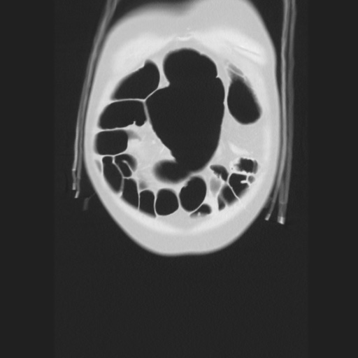 Cecal volvulus (Radiopaedia 75378-86620 Coronal lung window 25).jpg