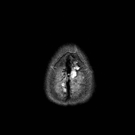 File:Central-variant posterior reversible encephalopathy syndrome (PRES) (Radiopaedia 43880-47359 Axial T2 24).jpg