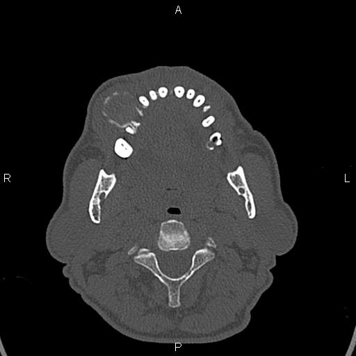 File:Central giant cell granuloma (Radiopaedia 83346-97761 Axial bone window 11).jpg