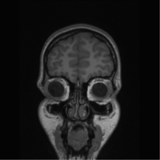 Central neurocytoma (Radiopaedia 37664-39557 Coronal T1 77).png