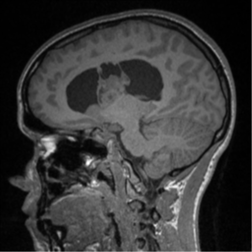 File:Central neurocytoma (Radiopaedia 37664-39557 Sagittal T1 42).png