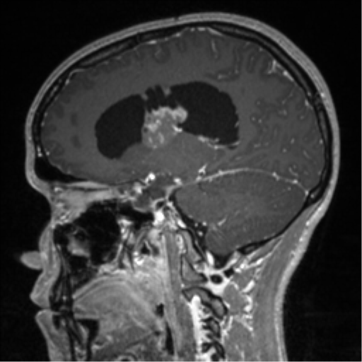 Central neurocytoma (Radiopaedia 37664-39557 Sagittal T1 C+ 41).png