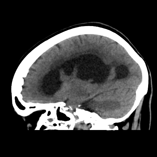 File:Central neurocytoma (Radiopaedia 65317-74346 C 33).png
