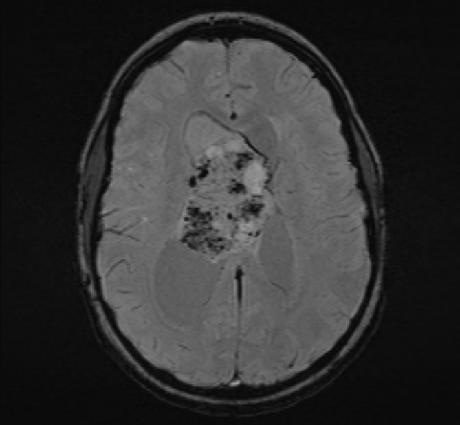 Central neurocytoma (Radiopaedia 70263-80336 Axial SWI 35).jpg