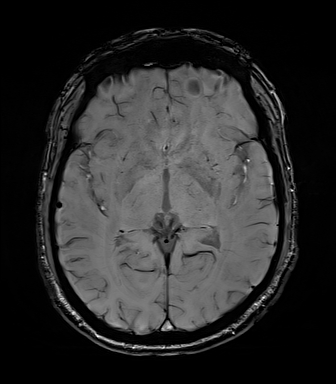 File:Central neurocytoma (Radiopaedia 71068-81303 Axial SWI 30).jpg