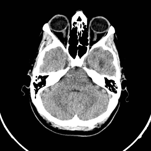 Central neurocytoma (Radiopaedia 84497-99871 Axial non-contrast 10).jpg