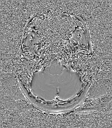 Central neurocytoma (Radiopaedia 84497-99872 Axial 11).jpg