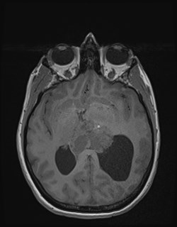 Central neurocytoma (Radiopaedia 84497-99872 Axial T1 100).jpg