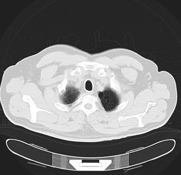 Centrilobular pulmonary emphysema (Radiopaedia 26808-26971 C 3).jpg