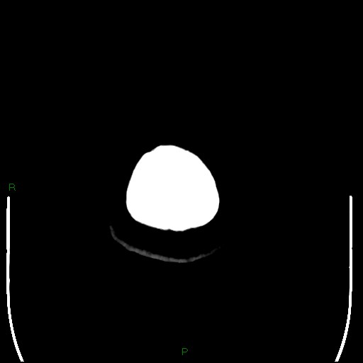 File:Cerebellar abscess (Radiopaedia 78135-90671 Axial non-contrast 115).jpg