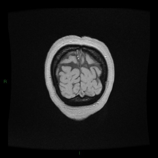Cerebellar abscess (Radiopaedia 78135-90678 Coronal T1 C+ 162).jpg