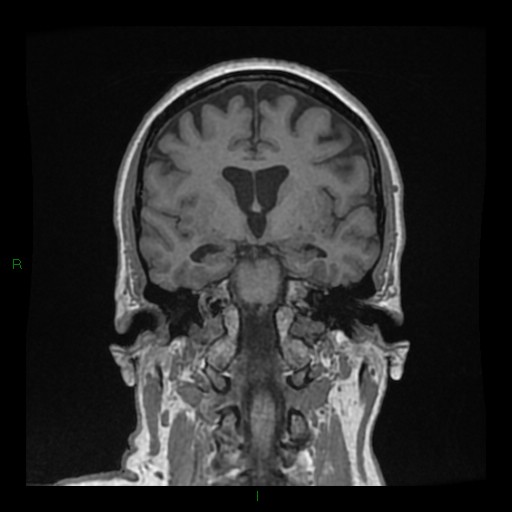 Cerebellar abscess (Radiopaedia 78135-90678 Coronal T1 C+ 79).jpg