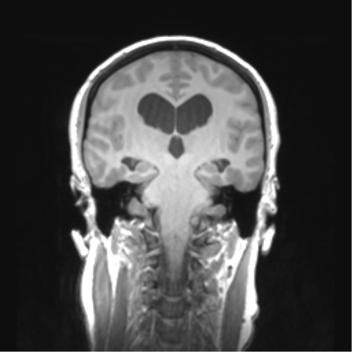 Cerebellar ependymoma complicated by post-operative subdural hematoma (Radiopaedia 83322-97736 Coronal T1 31).png