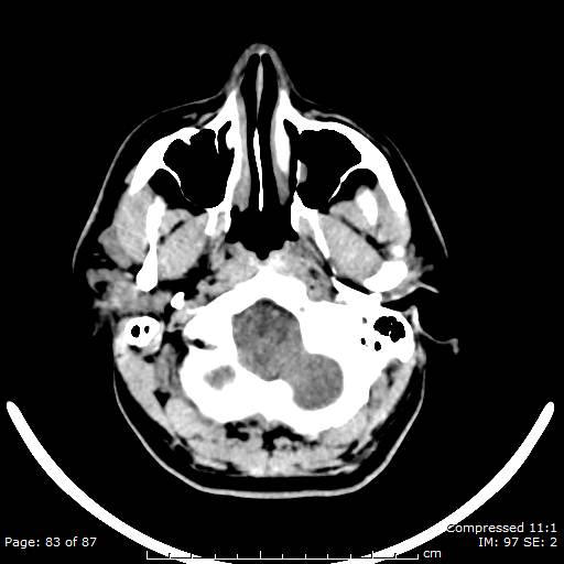 Cerebellar hemangioblastoma (Radiopaedia 52360-58258 Axial non-contrast 83).jpg