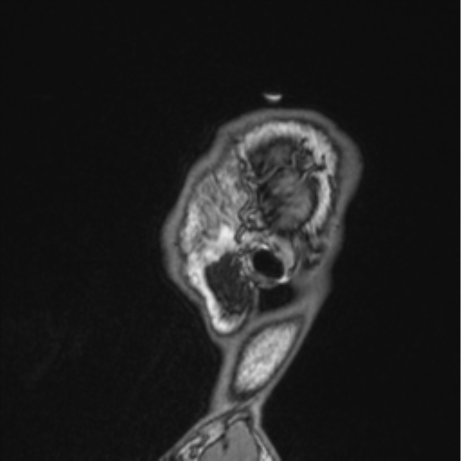 Cerebellar hemangioblastomas and pituitary adenoma (Radiopaedia 85490-101176 Sagittal T1 18).png