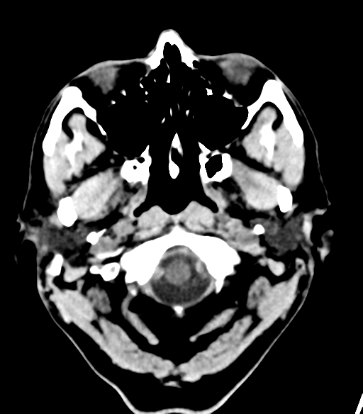 File:Cerebellar hemorrhage (Radiopaedia 37000-38669 Axial non-contrast 5).png