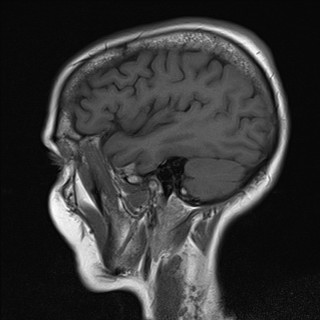 File:Cerebellar metastases (Radiopaedia 24038-24249 Sagittal T1 2).jpg