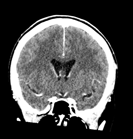 Cerebellar metastases - colorectal adenocarcinoma (Radiopaedia 40947-43652 Coronal C+ 40).png