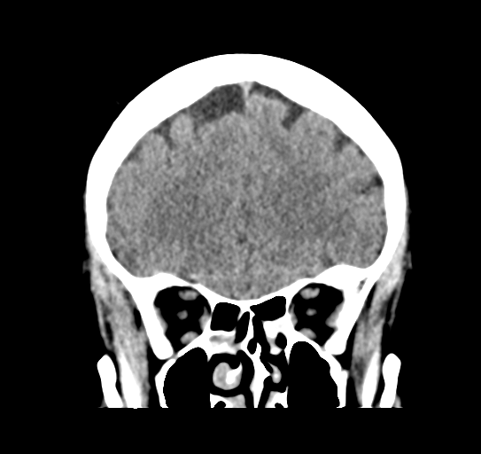 File:Cerebellar metastasis (Radiopaedia 54578-60812 Coronal non-contrast 14).png