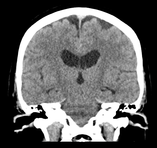 File:Cerebellar metastasis (Radiopaedia 54578-60812 Coronal non-contrast 31).png