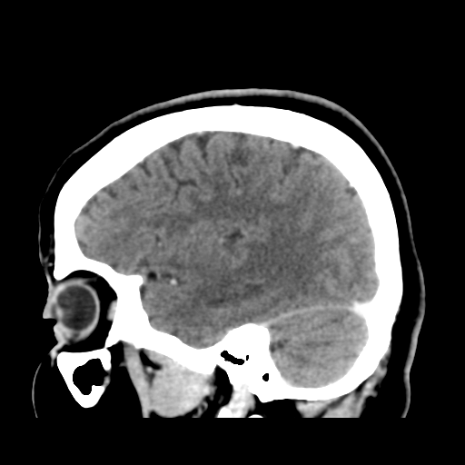 Cerebellar metastasis (cystic appearance) (Radiopaedia 41395-44258 F 15).png