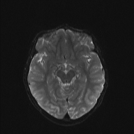 File:Cerebellar stroke (Radiopaedia 32202-33150 Axial DWI 11).png