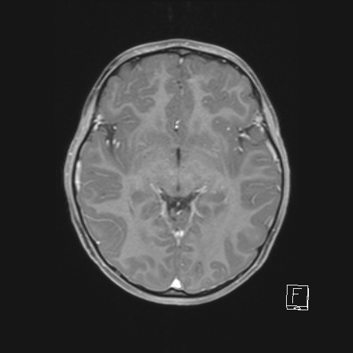 Cerebellar stroke (Radiopaedia 32202-33150 Axial T1 C+ 37).png